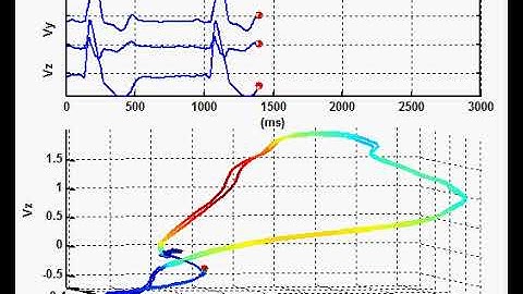 Spatiotemporal VCG representation of a patient with bundle branch block