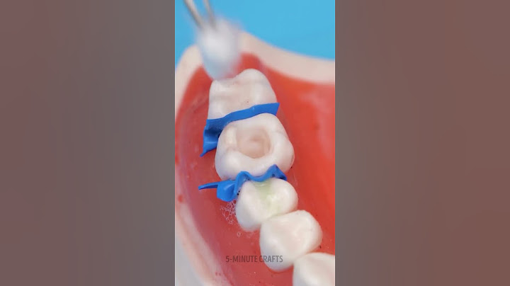 What Removing a Cavity Looks Like Through a Dentist’s Eyes! 🦷👀✨