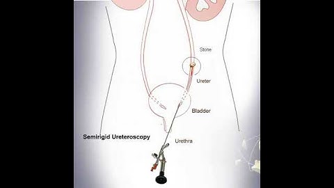 Ureteroscopy | Treatment of lower and middle ureteral stone #shorts #short #shortvideo #shortsvideo
