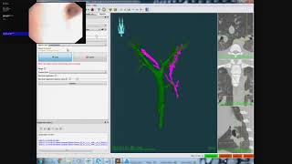 Automated airway registration using CustusX and Anser EMT