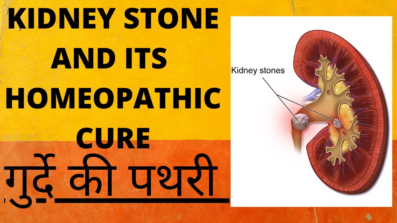 kidney stone ||  kidney stone homeopathic medicine || best homeopathic medicine for kidney stone !