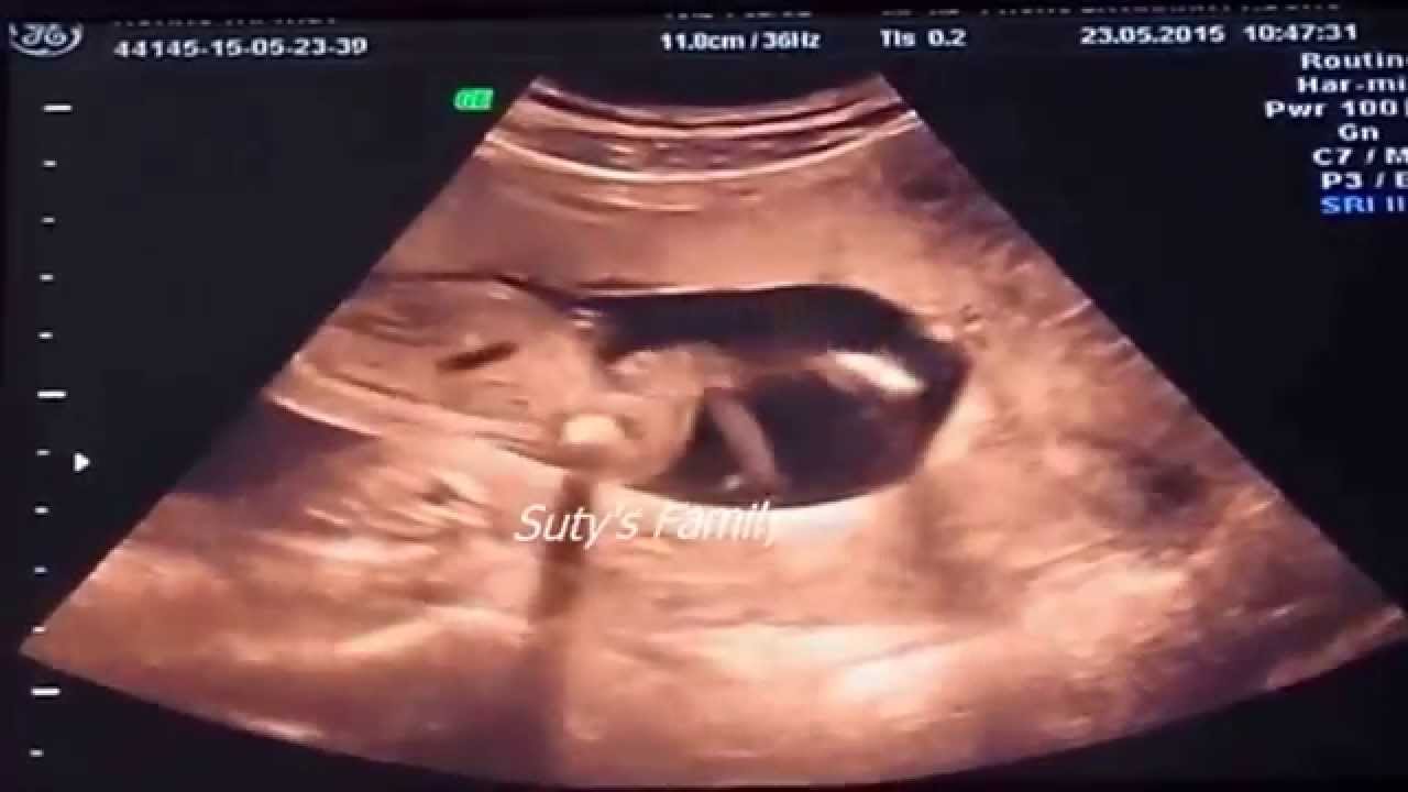 Baby Dancing In Mother S Womb Youtube Baby Dancing In Mother S Womb Youtube