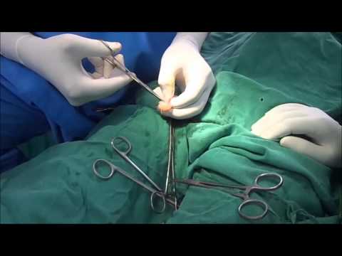 Video: Spermatic Cord Cyst: Treatment, Consequences For Boys And Men