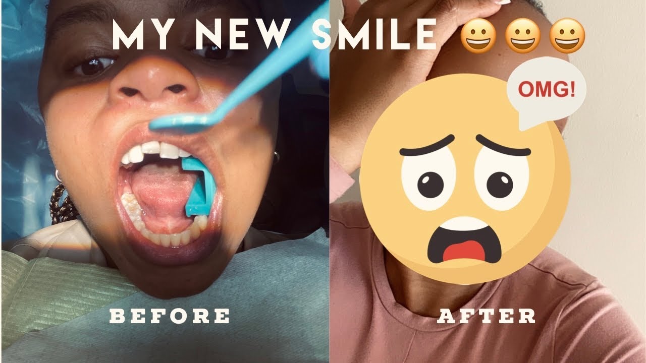 MY NEW SMILE IN JUST 3 MONTHS
