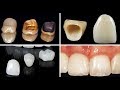 أسباب أختلاف أسعار وكلفة تركيب الأسنان و إبتسامة هوليود بين طبيب أسنان وأخر