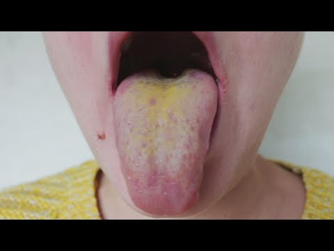 Video: Causes Of Yellow Plaque On The Tongue Of A Child