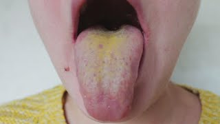 Yellow Tongue Spot Explained!