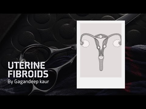 Video: Sådan Bliver Du Gravid Med Uterine Fibromer