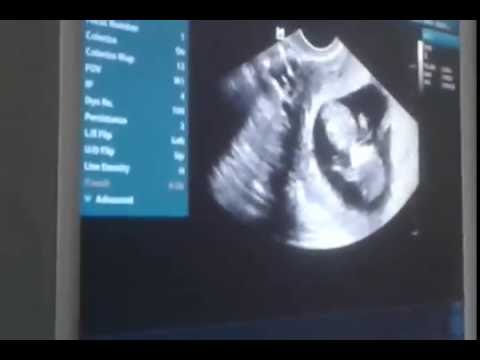 شاهد The Fetus 11 Weeks Old Youtube