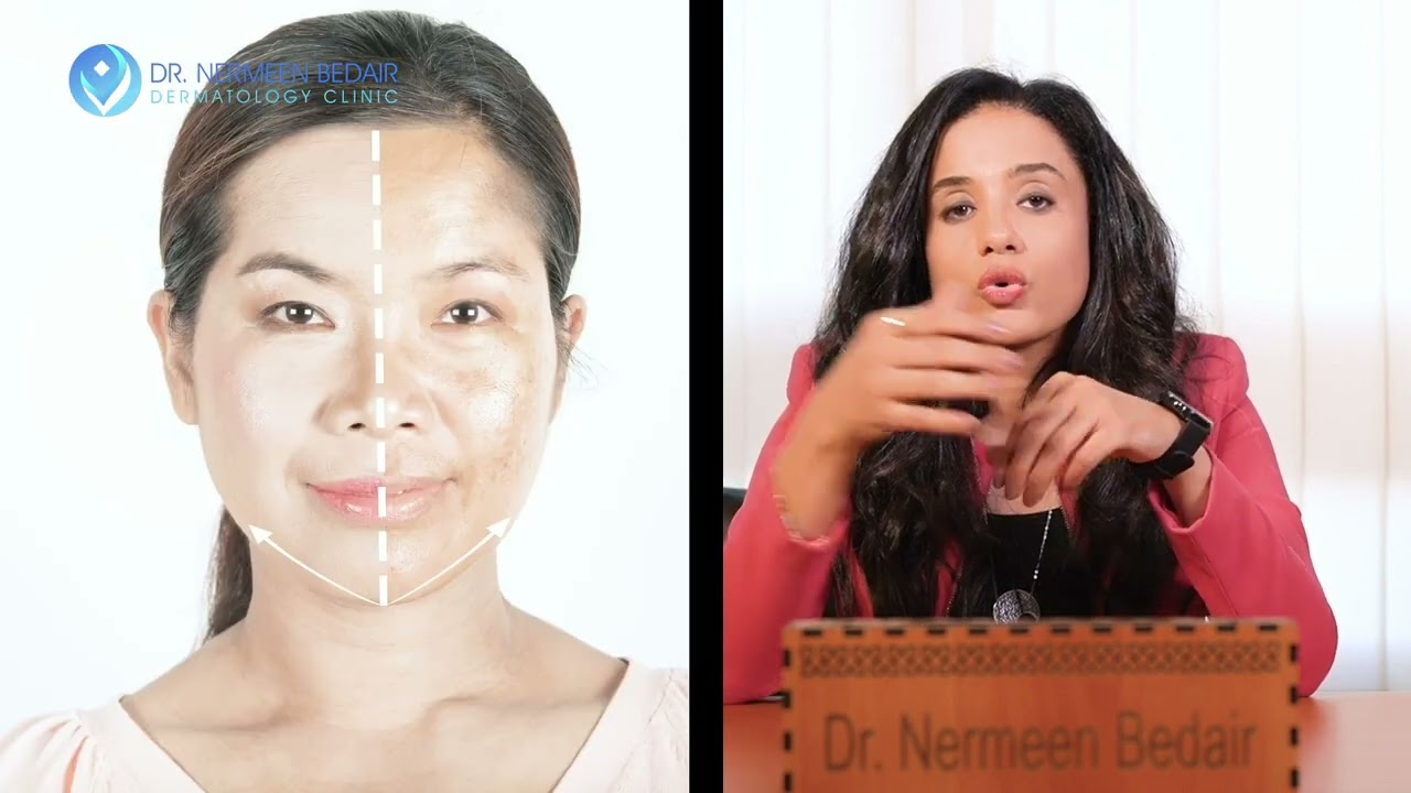 د. نيرمين بدير: الكلف وتصبغات الوجه