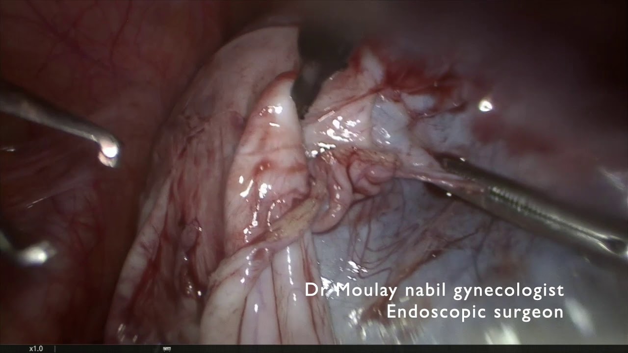 Managementof a big ovarian cyst in the context of infertilit