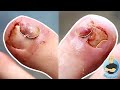 HUGE TOE FLAPS AND PAINFUL INGROWN TOENAILS REMOVED!!!