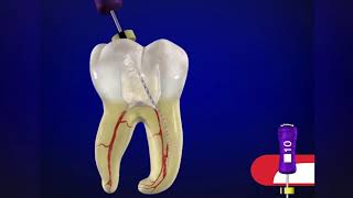 ProTaper Gold® SX file with Dr. Cliff Ruddle  | Dentsply Sirona