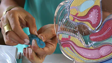 Come posizionare la coppetta per il ciclo?