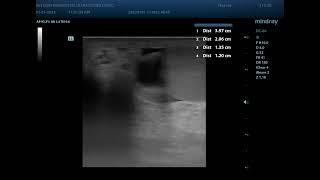 Epididymal cyst ultrasound Epididymal Cyst Ultrasound Case 51
