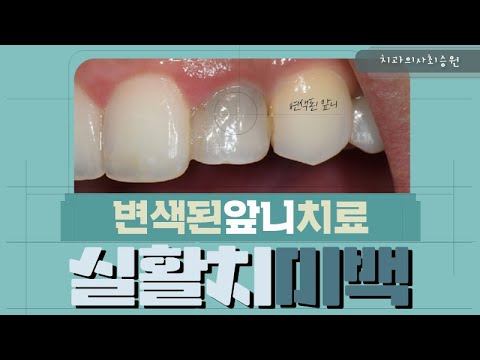 어둡게 검게 변색된 <strong>앞니치료</strong>! 실활치미백
