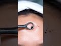 Deep Pore Cleaning with Blackhead Vacuum (Real Results)