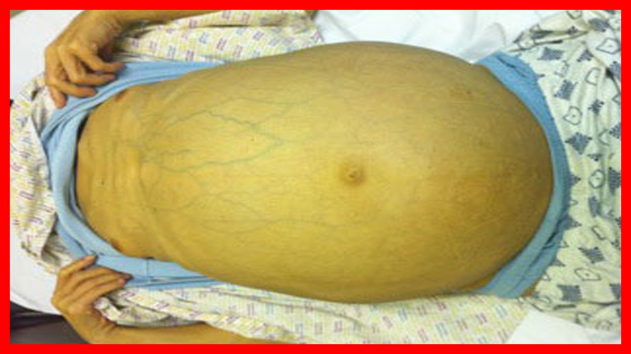 Hepatitis B. Sintomas, Signos, Tratamiento, Vacuna y Complicaciones sida origine