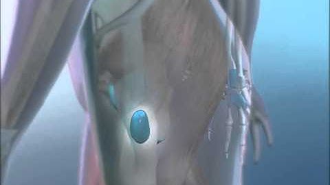 Bursitis: Learn@Visible Body