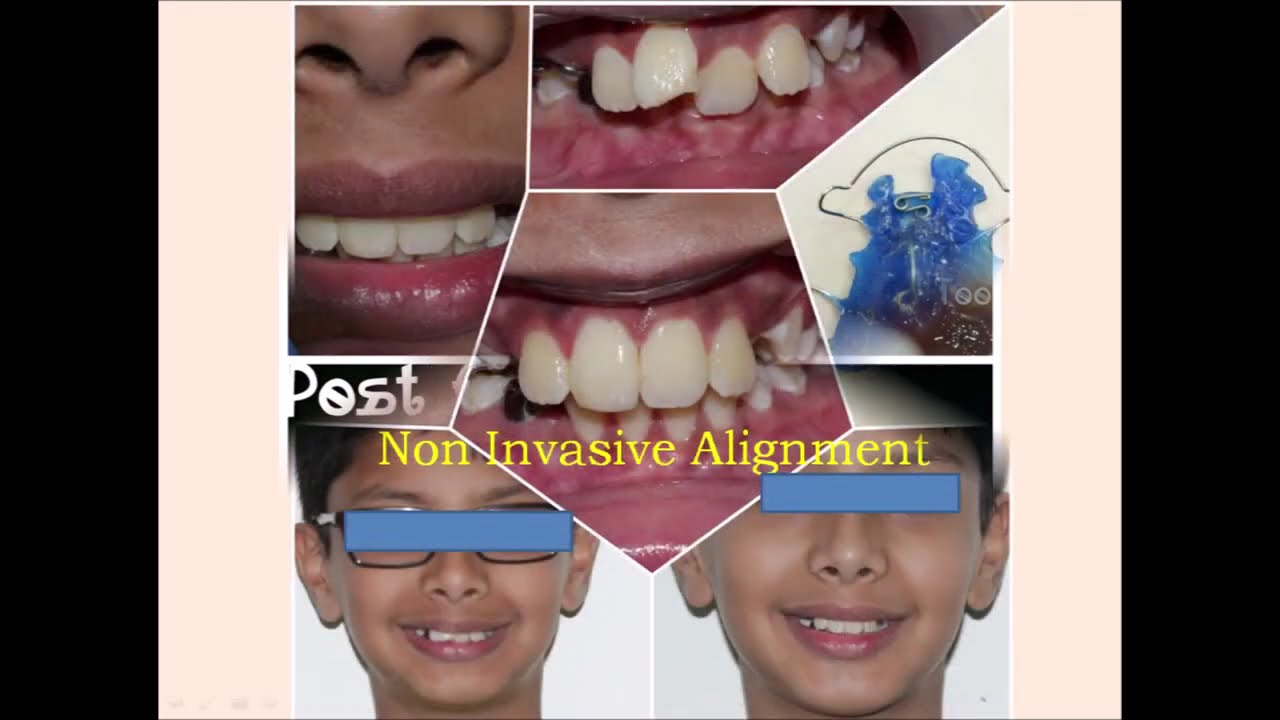 Smile Designing | Toothtown Dental Clinic, Nava India, Coimbatore | Crafted Smiles | Creating Smile