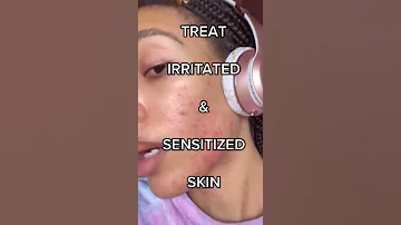 HOW TO TREAT IRRITATED AND SENSITIZED SKIN (fast and easy‼️😅)