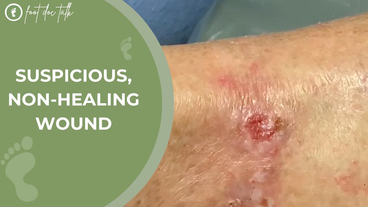 Suspicious Non-Healing Wound - YouTube
