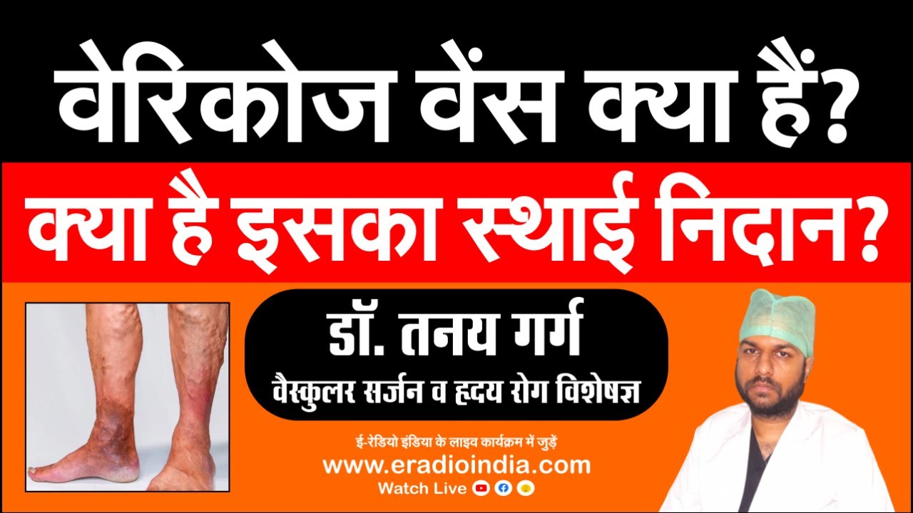 varicose-veins-meaning-in-hindi-varicose-veins-treatment-in-hindi