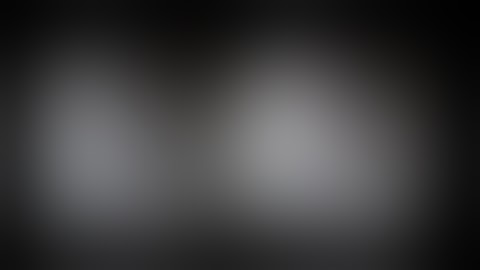 PERCUTANEOUS NEPHROLITHOTOMY (PCNL) IN MALROTATED KIDNEY