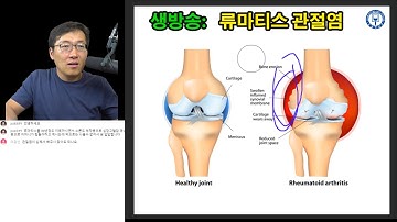 류마티스 관절염 치료: 보충설명 & 비약물 치료