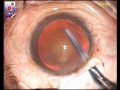 Small incision cataract surgery