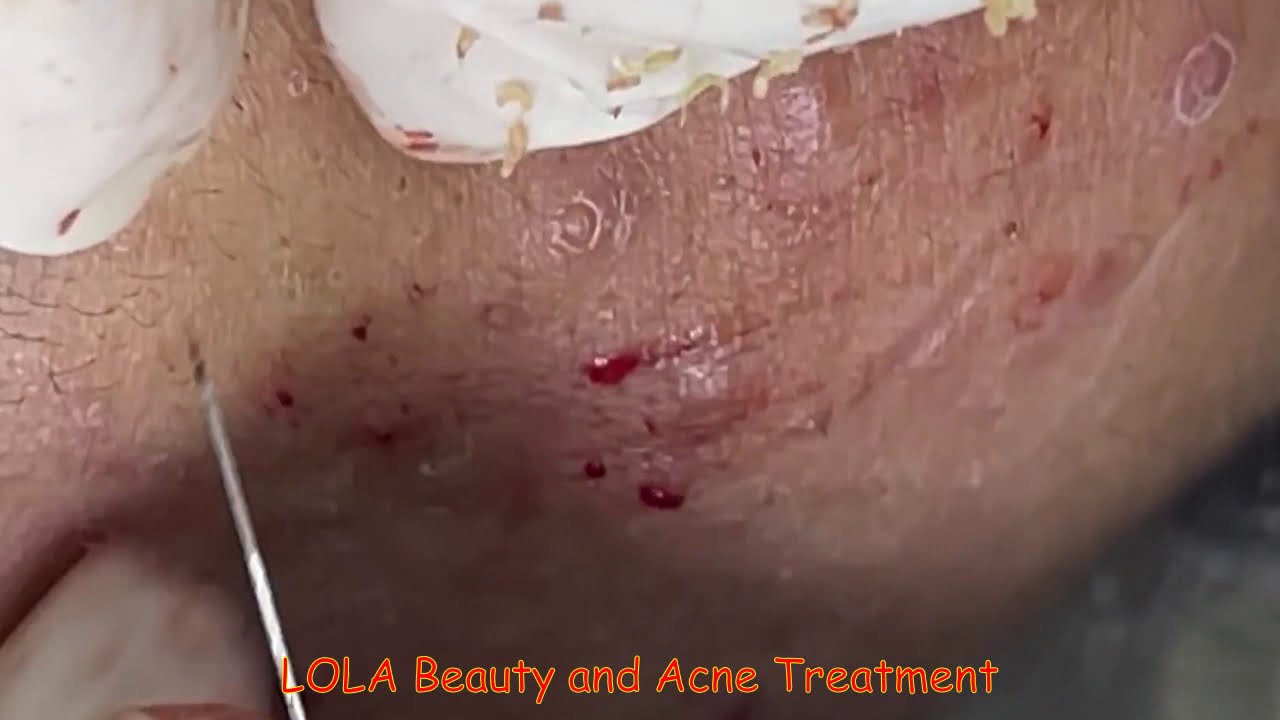 I Just Wanna Be Happy; Acne Removal 45;  (Full Screen) Super Big Pops