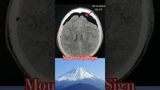 Pneumocephalous CT Brain|Mount Fuji Sign #neurology #neurosurgery #medicine #doctor #headinjury