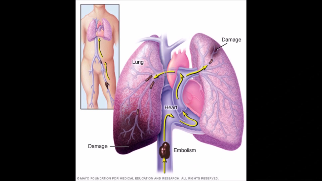 Тромболия легочной артерии. Тромбоэмболия легочной артерии симптомы. Тромбоэмболия легочных сосудов симптомы. Синдром тромбоэмболии легочной артерии. Инфаркт легкого тромботический.