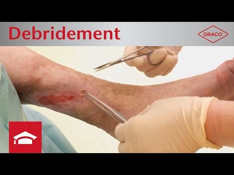 Video: Solltest du eine Verbrennung debridieren?