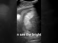 Fetal echogenic bowel i fetal medicine ultrasound doctor ultrasoundtechnologist informational