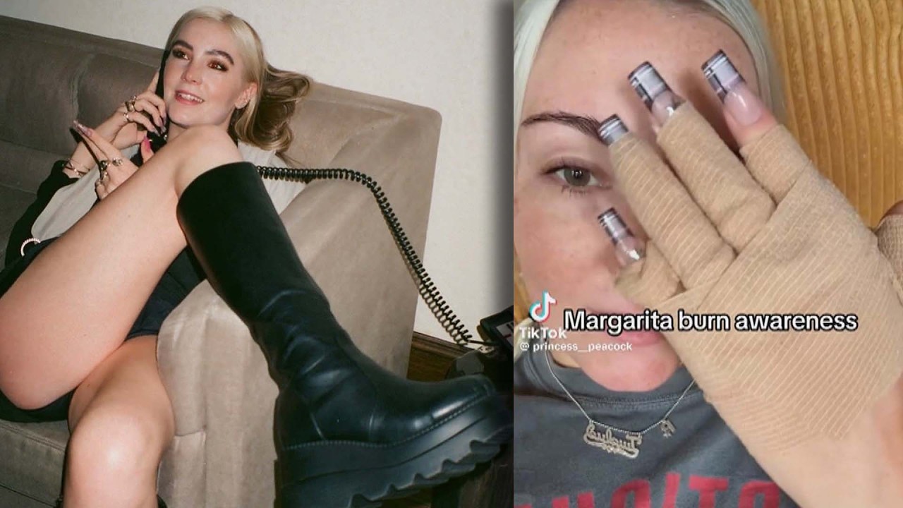 Woman Gets Second-Degree Burns On Hands After Making Margaritas