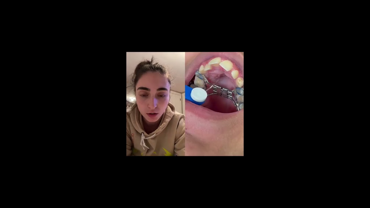 My Orthodontist Makes Me Do This Every Night Reacts