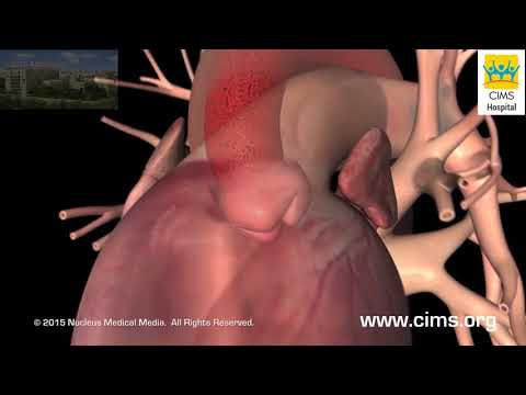 Echocardiogram (Hindi) - CIMS Hospital