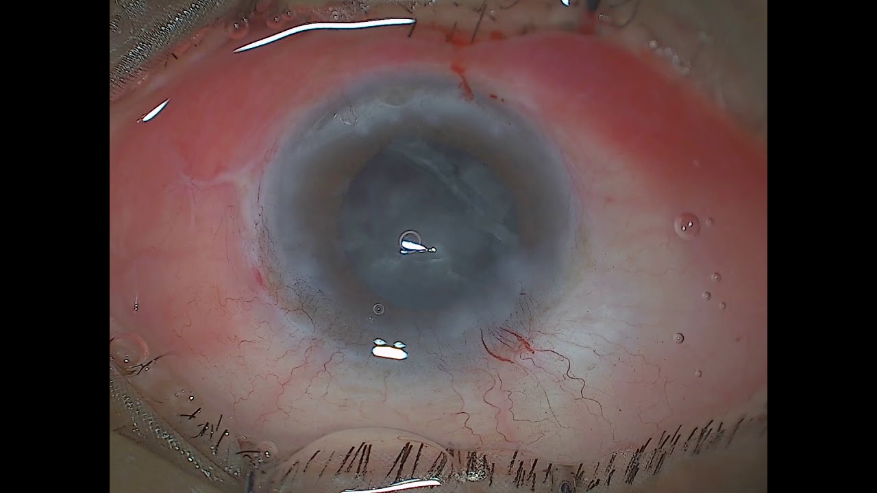 Phaco In Hazy Cornea YouTube phaco-in-hazy-cornea-youtube