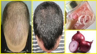 20 दिनों में प्याज के रस से बालों को Regrowth करे | Onion Juice For Hair Loss And Hair Regrowth