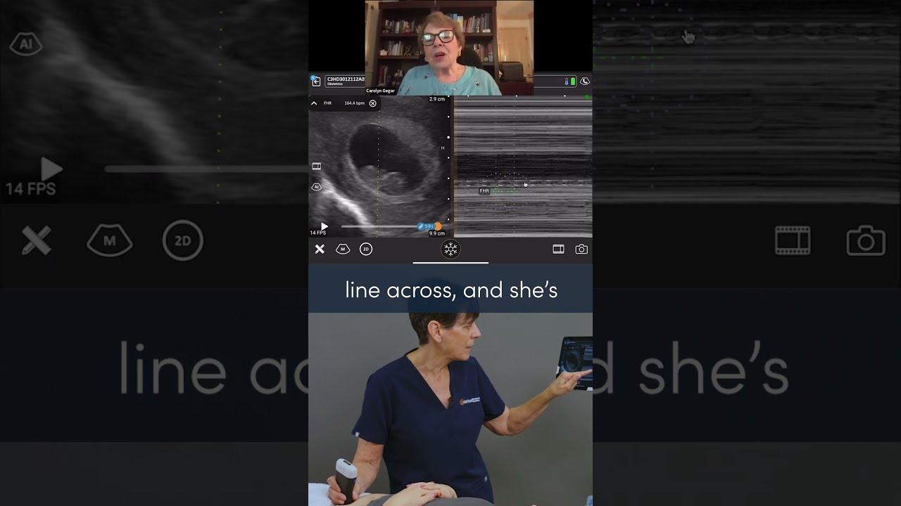 How To Measure The Fetal Heart Rate With U S