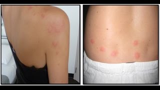 Bed bug bites vs Flea bites pictures/Images