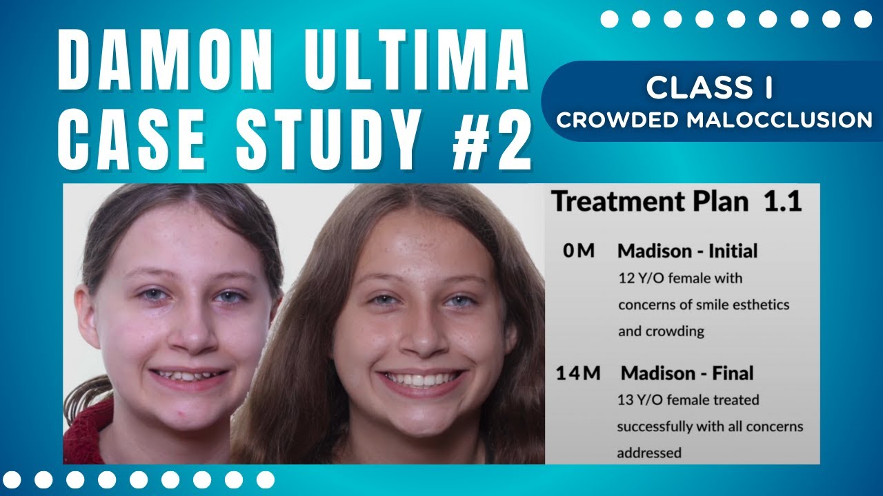 How We Fixed Crowding & Rotation with Damon Ultima - YouTube