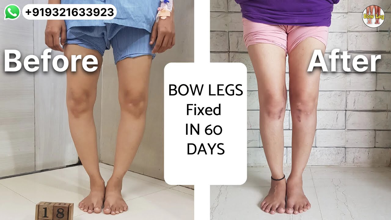 32 years old Mumbai girl operated both bowlegs ||BOW LEGS Fixed in 60 days|| Height also increased.