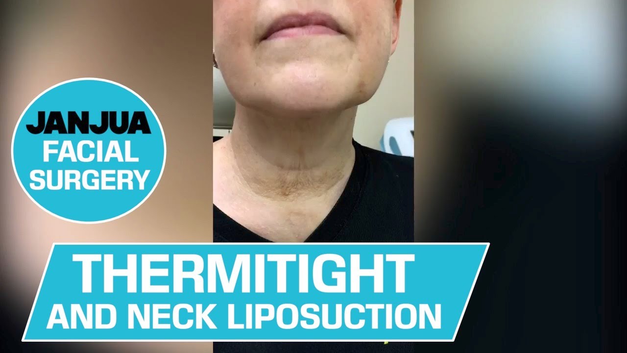 THERMITIGHT AND NECK LIPOSUCTION AT 1 WEEK POST OP - DR. TANVEER JANJUA - NEW JERSEY