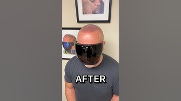 AMAZING SCALP MICROPIGMENTATION!!!INCREDIBLE TRANSFORMATIONS!!! @supremesmp2047