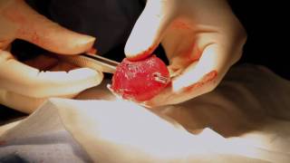 Prostate enlargement uncovered. What you need to know