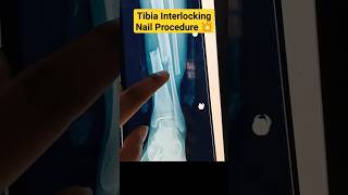 रॉड सरिया पैर में💥 Tibia Interlocking Nail 🔥#tibia #tibiafracture #fracturerecovery #fracture #bone