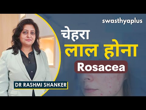 वीडियो: Rosacea को कैसे साफ़ करें: क्या प्राकृतिक उपचार मदद कर सकते हैं?
