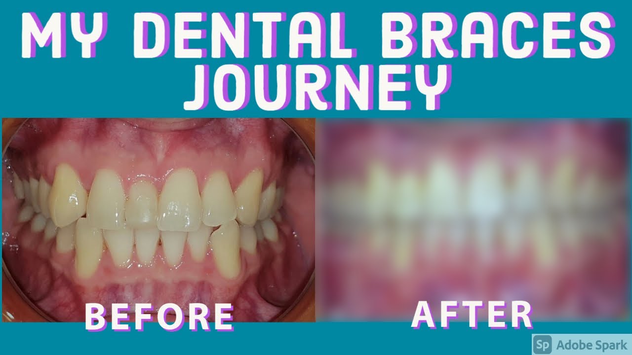 Braces Journey removing my Mesiodens YouTube